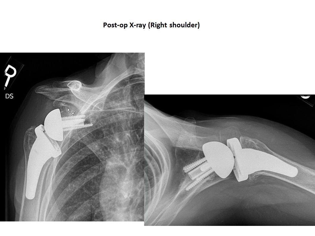 Reverse Total Shoulder Replacement Boston Shoulder Institute