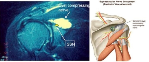 Suprascapular Neuropathy Boston Shoulder Institute