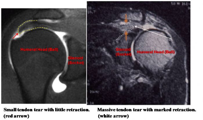 Irreparable Rotator Cuff Tears Boston Shoulder Institute