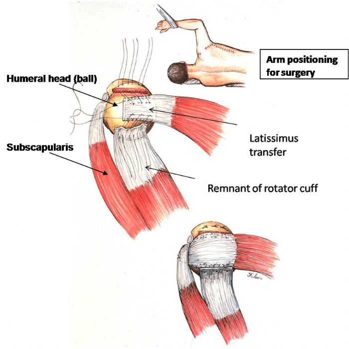 Irreparable Rotator Cuff Tears Boston Shoulder Institute