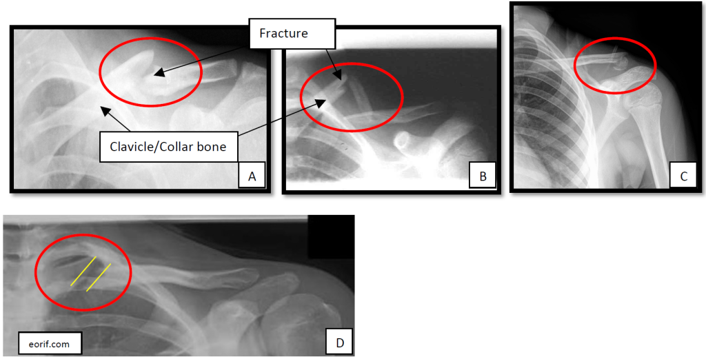 Clavicle (Collar Bone) Fractures | Boston Shoulder Institute