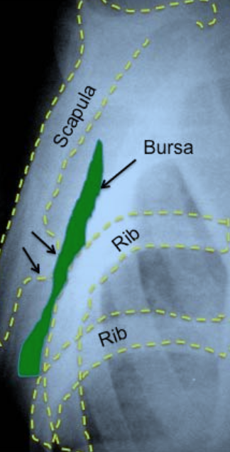 Scapulothoracic Bursitis | Boston Shoulder Institute