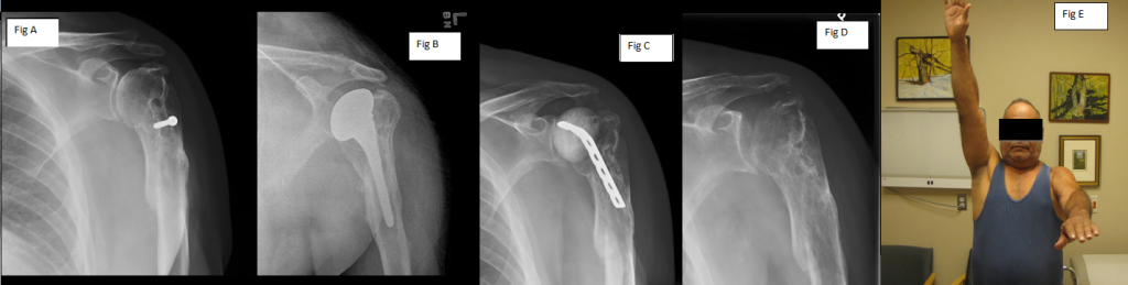 Boston Shoulder Institute Resection Arthroplasty