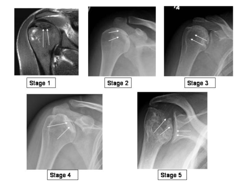 Avascular Necrosis Boston Shoulder Institute 9211