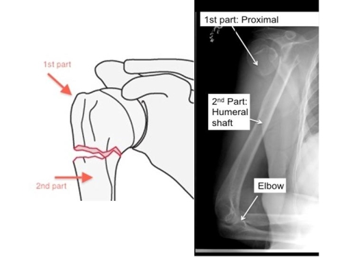 A two part fracture