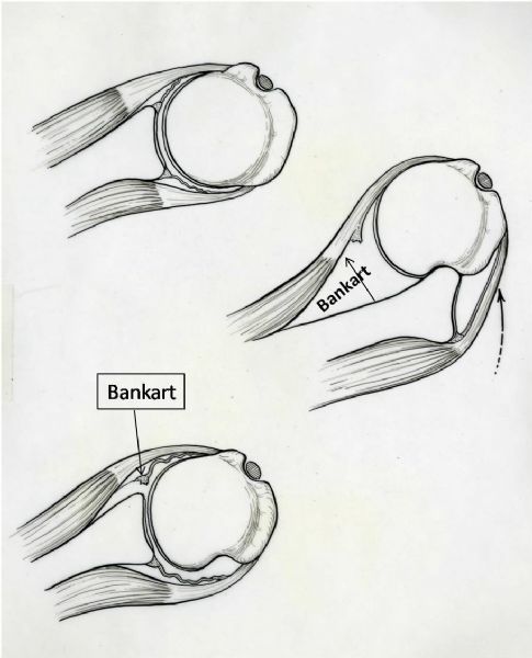 Банкарта плечевого сустава. Повреждение костный Банкарт.