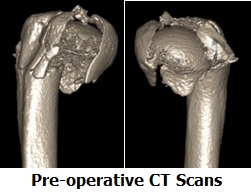 Fracture pre-op