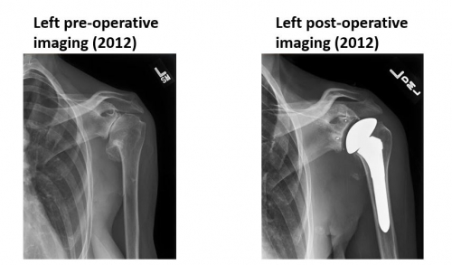 7 Shoulder ideas  shoulder replacement surgery, rotator cuff surgery, shoulder  surgery