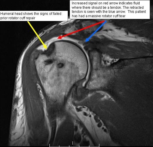 Boston Shoulder Institute – MRI rotator cuff tear