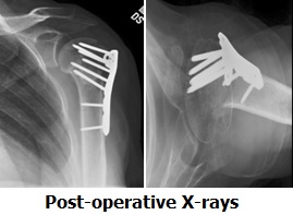 fracture post-op