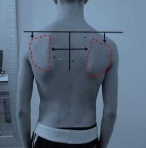 Sindromul de snapping scapula