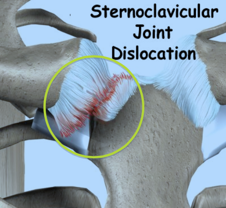 sternoclavicular-joint12