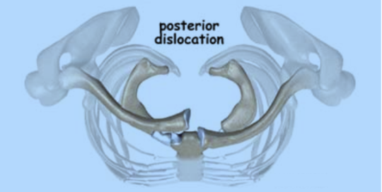 Sternoclavicular Joint Boston Shoulder Institute