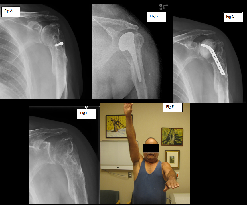 resection arthroplasty1