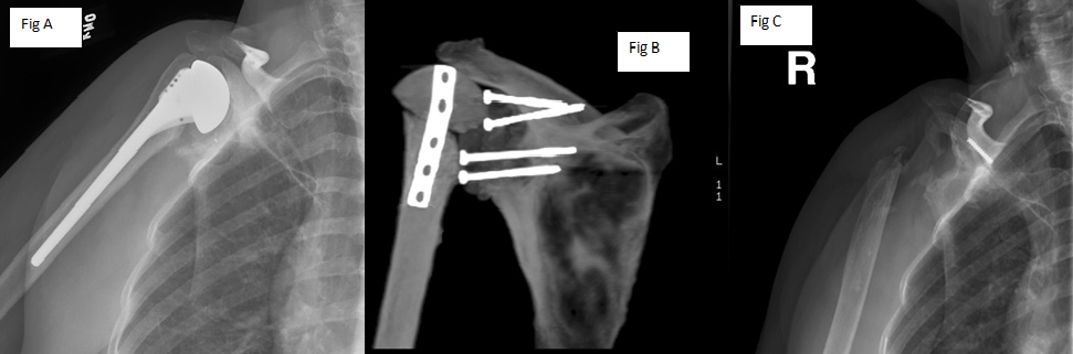 resection arthroplasty