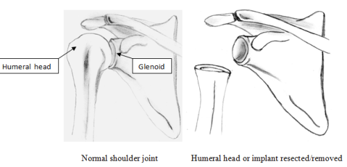 Resection Arthroplasty | Boston Shoulder Institute