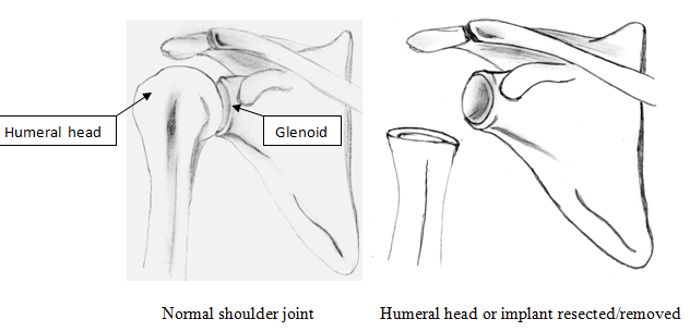 resection arthroplasty