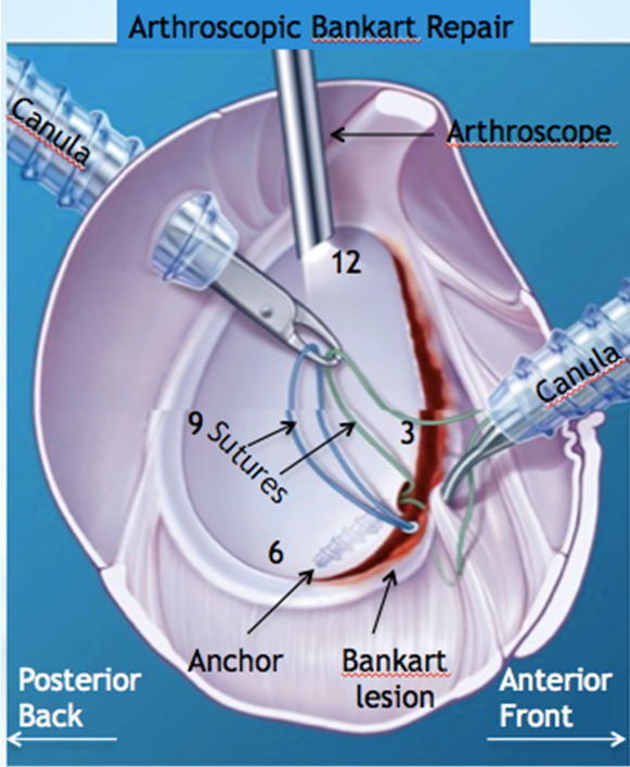 Anchors And Shoulder Surgery at Cathy Hudson blog