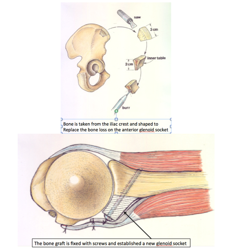 glenoid 2