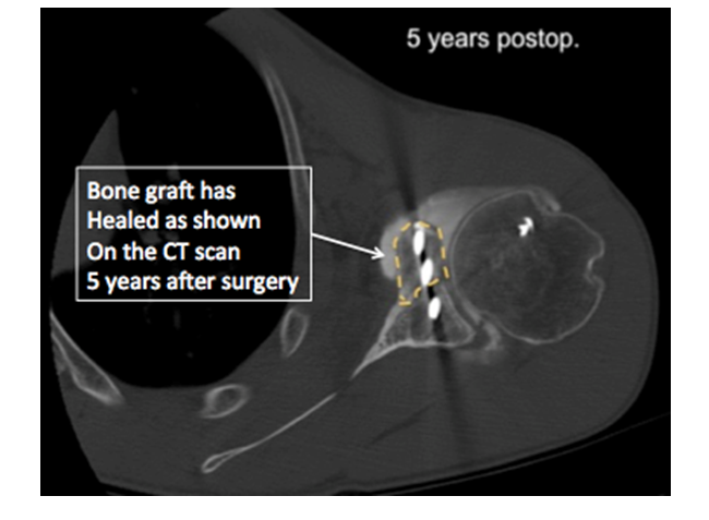 glenoid 3