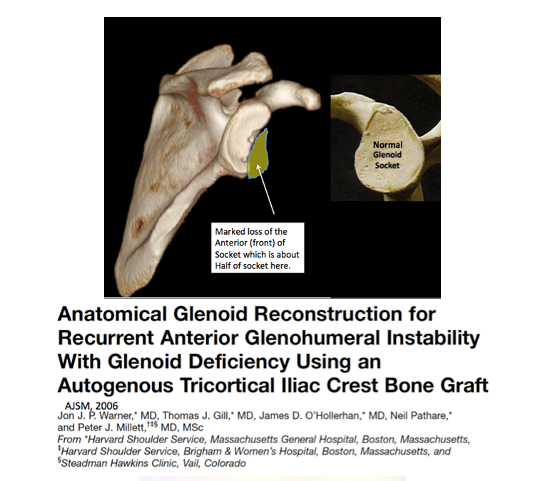 glenoid