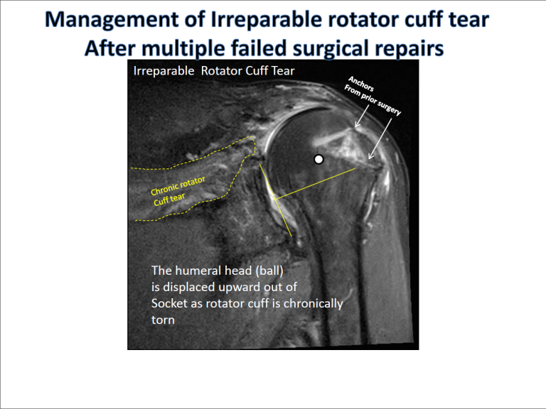 New Approaches in RSA | Boston Shoulder Institute