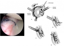 Boston Shoulder Institute – 12 capsulolabral reconst